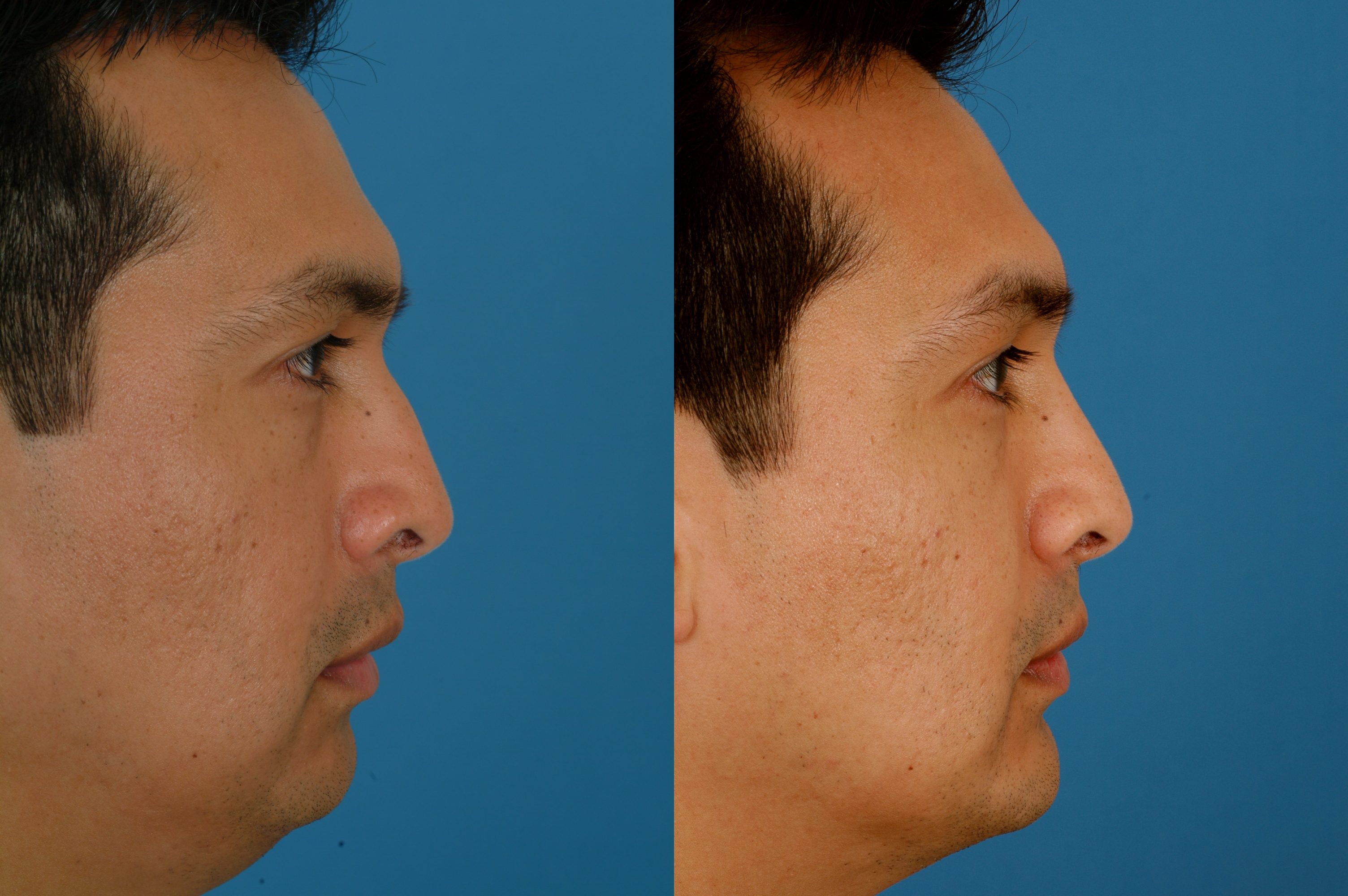 Advanced Facial Plastic Surgery 74