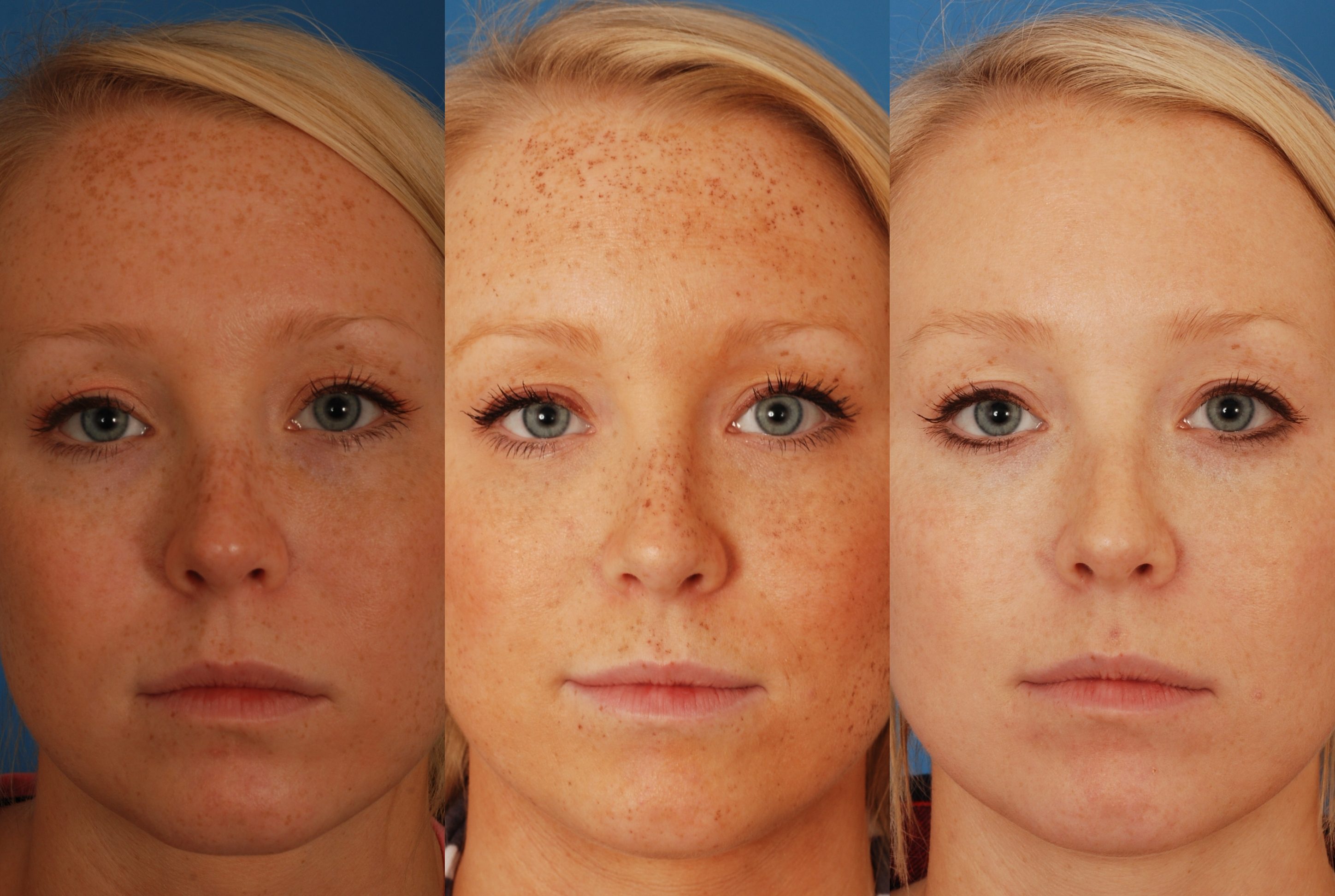 PHOTOFACIAL1 Dallas Advanced Facial Plastic Surgery Center