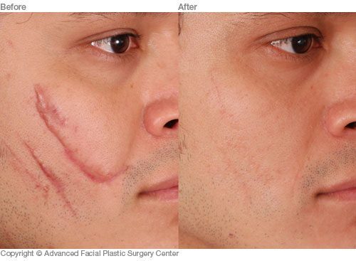 Scar Removal Plastic Surgery
