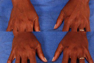 Hand-Rejuvenation