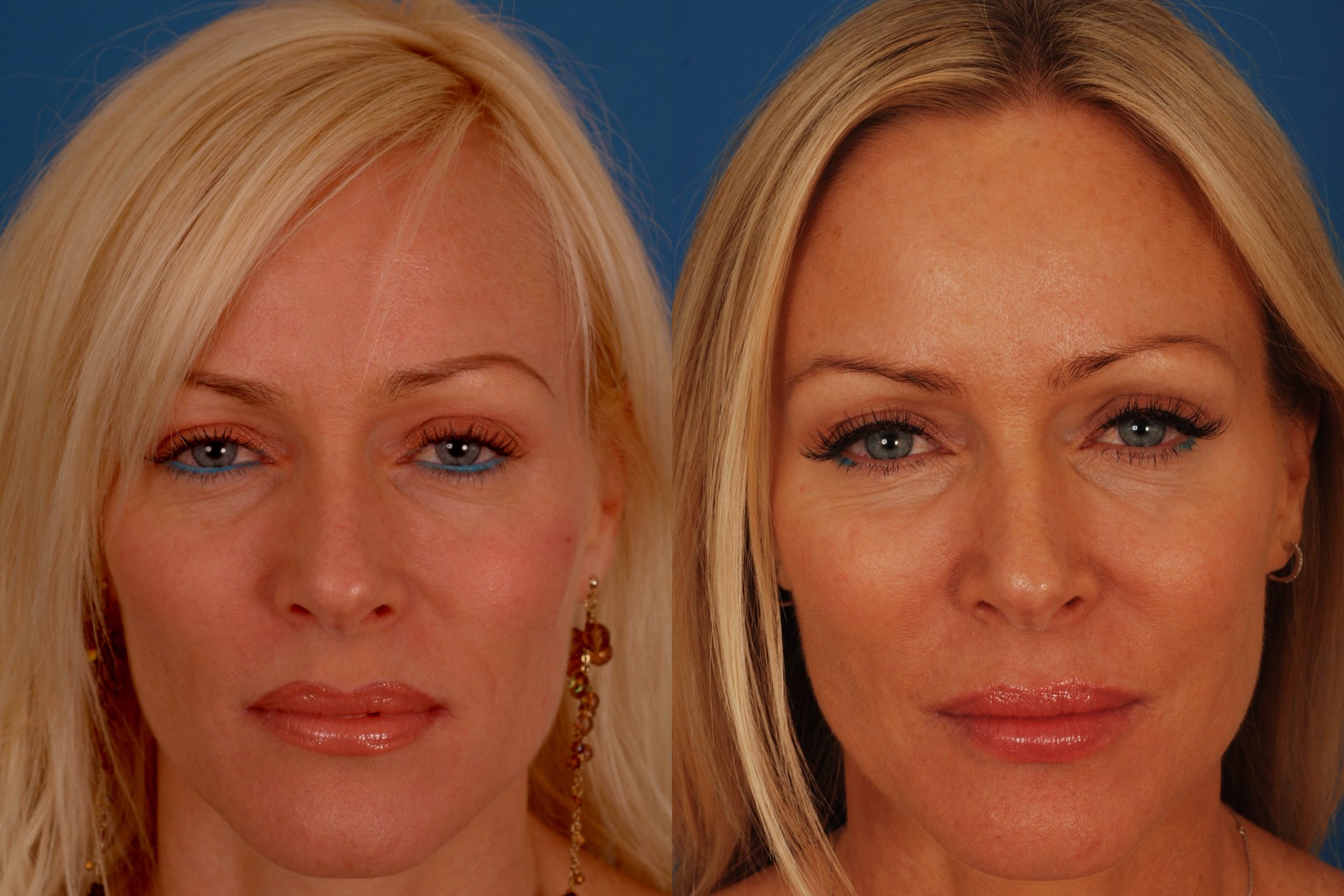 Botox Full Face Antes E Depois Not cias E Entretenimento