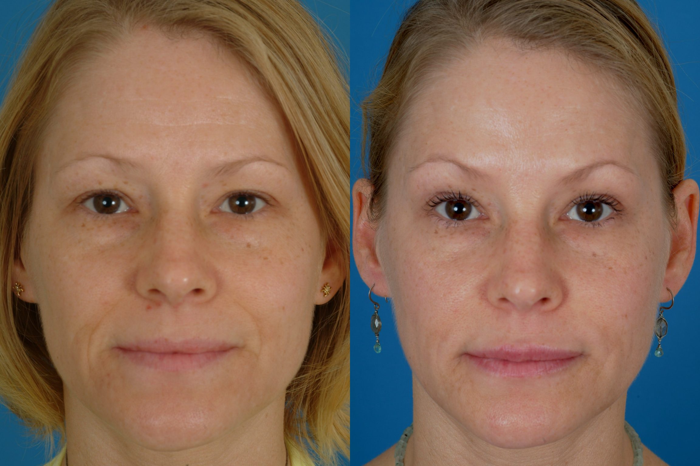Botox-2 – Dallas Advanced Facial Plastic Surgery Center
