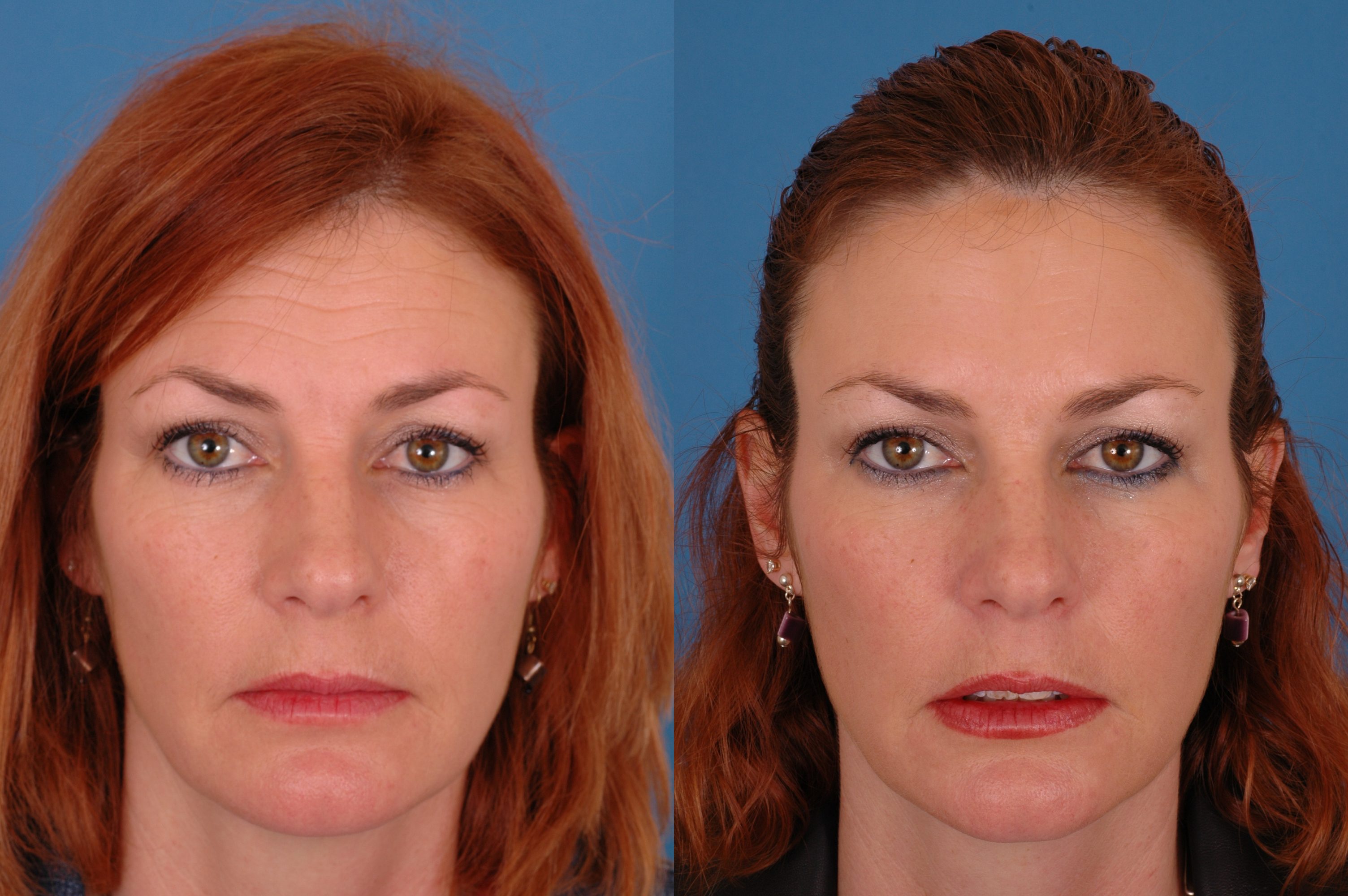 Botox Before & After Photos.