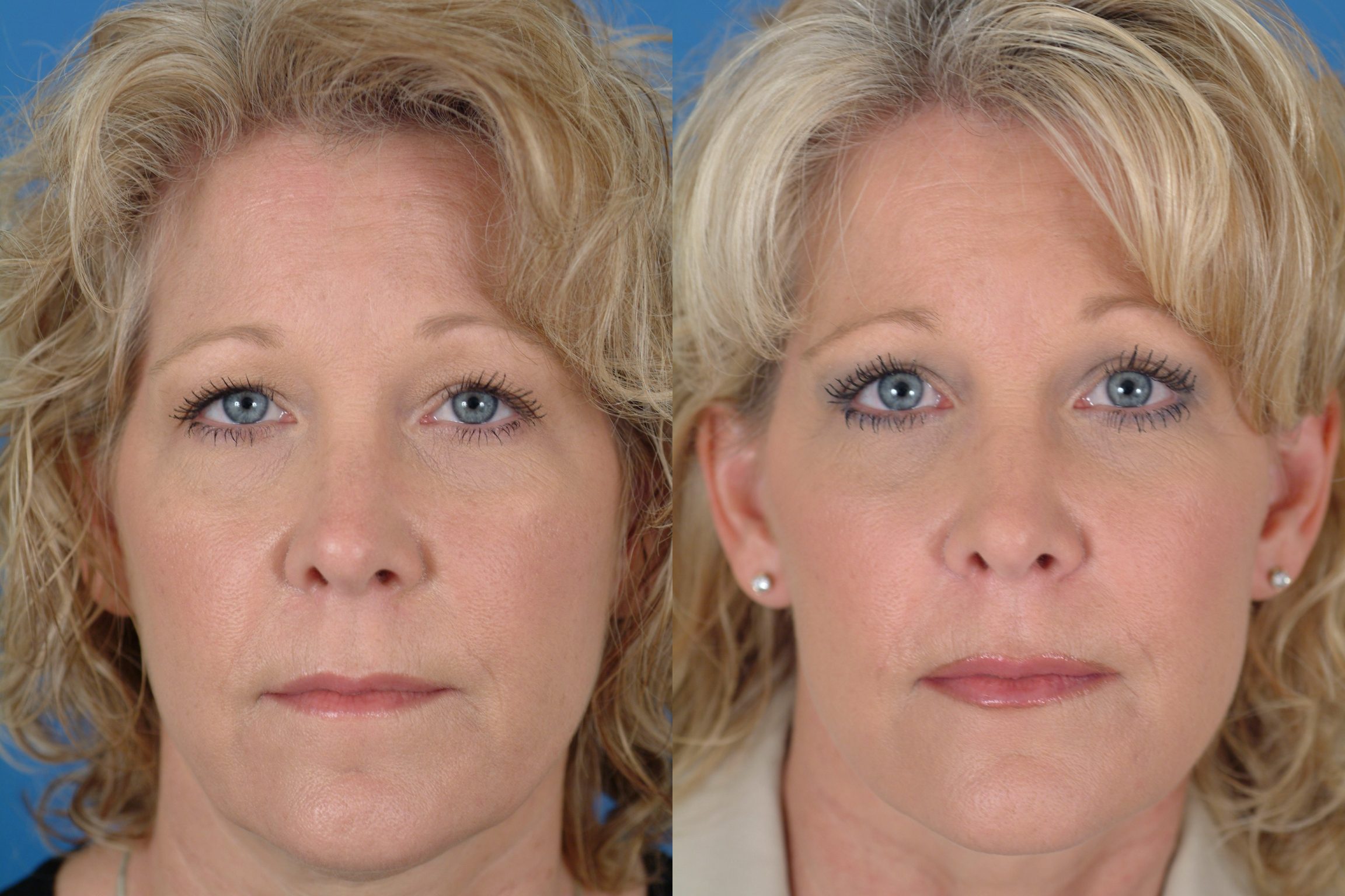 Facelift Before & After Photos.