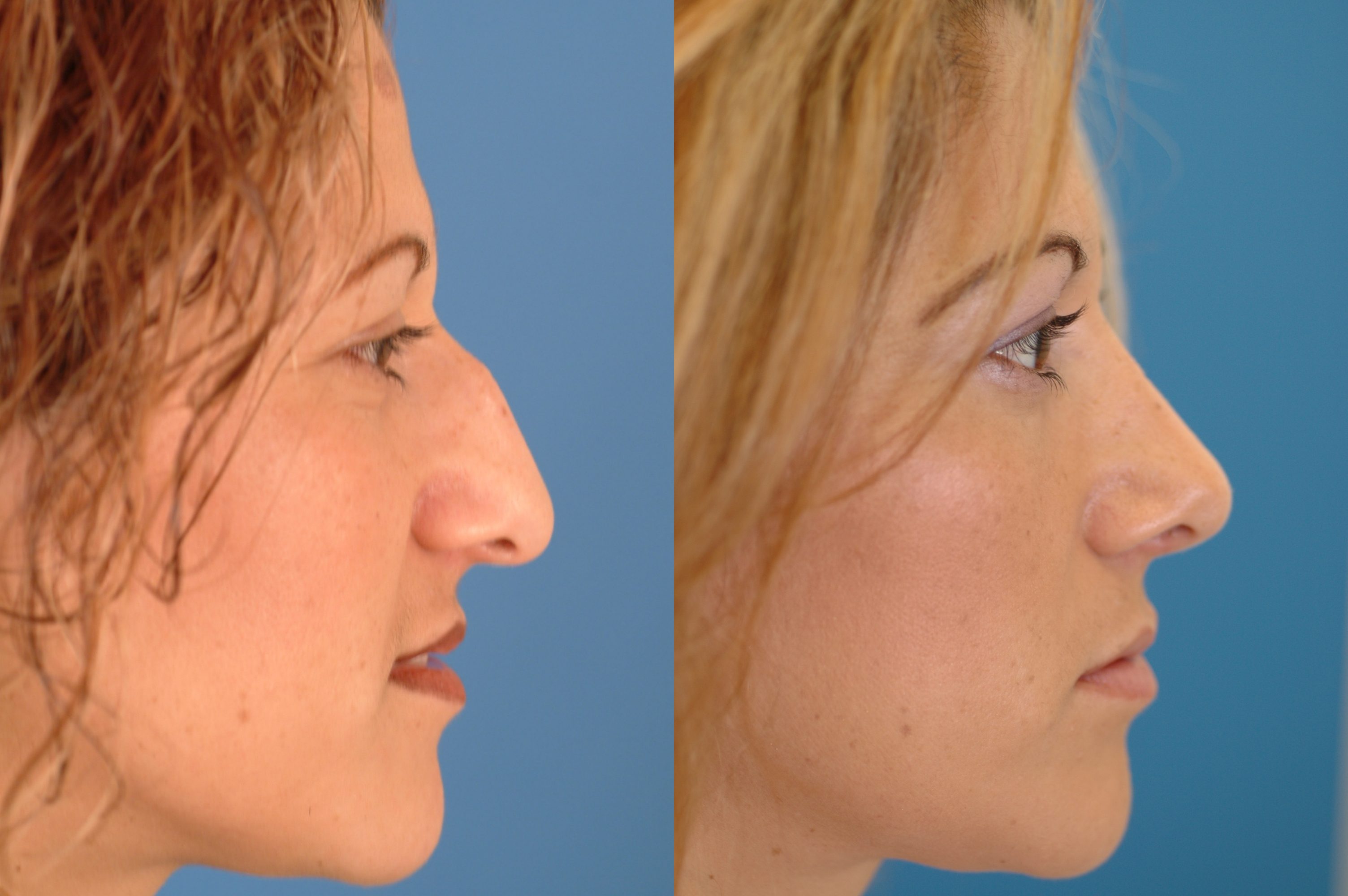 Nasal Surgery Before & After Photos Dr. Benjamin Bassichis