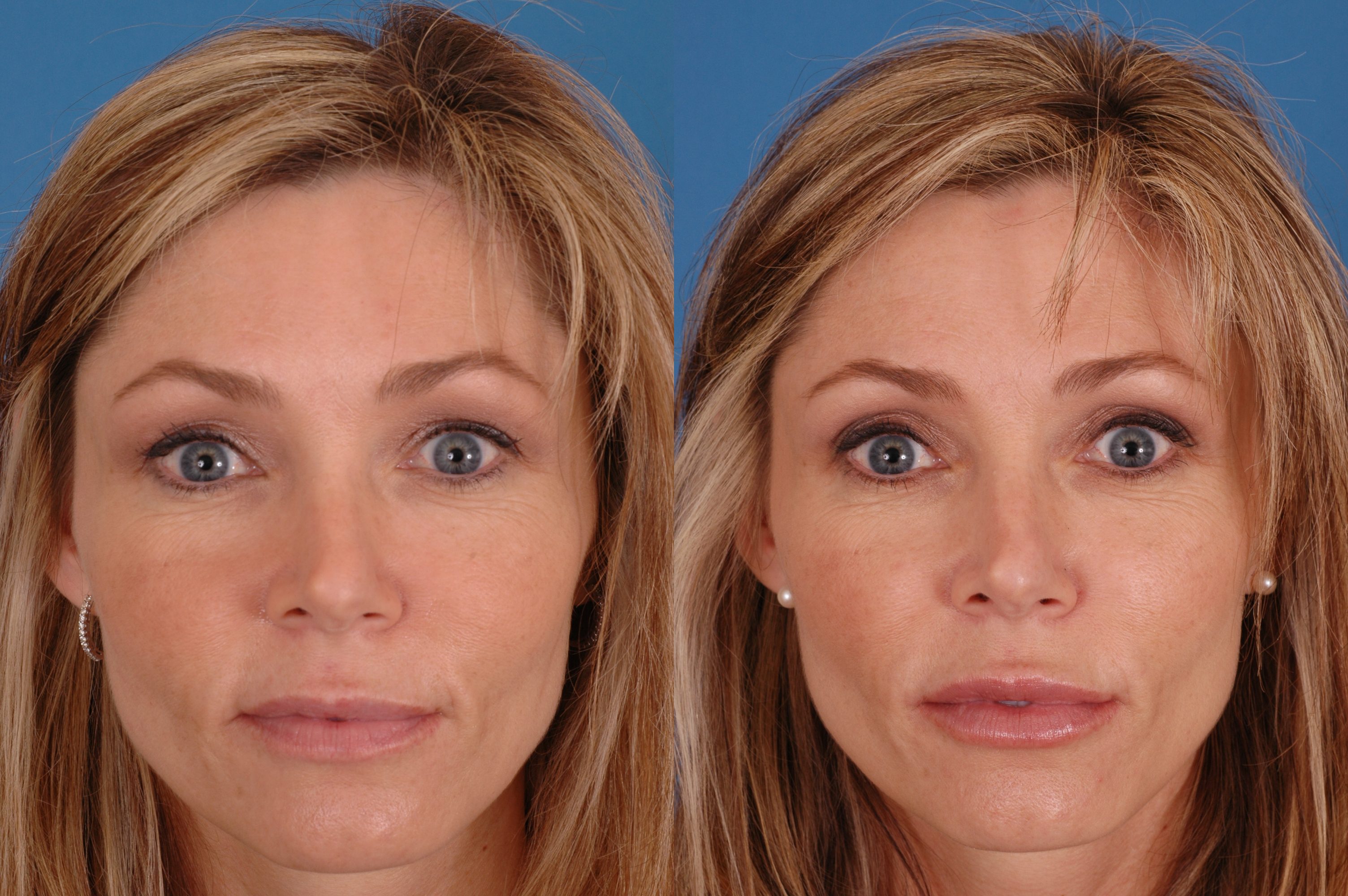 Injectable Fillers Before & After Photos.