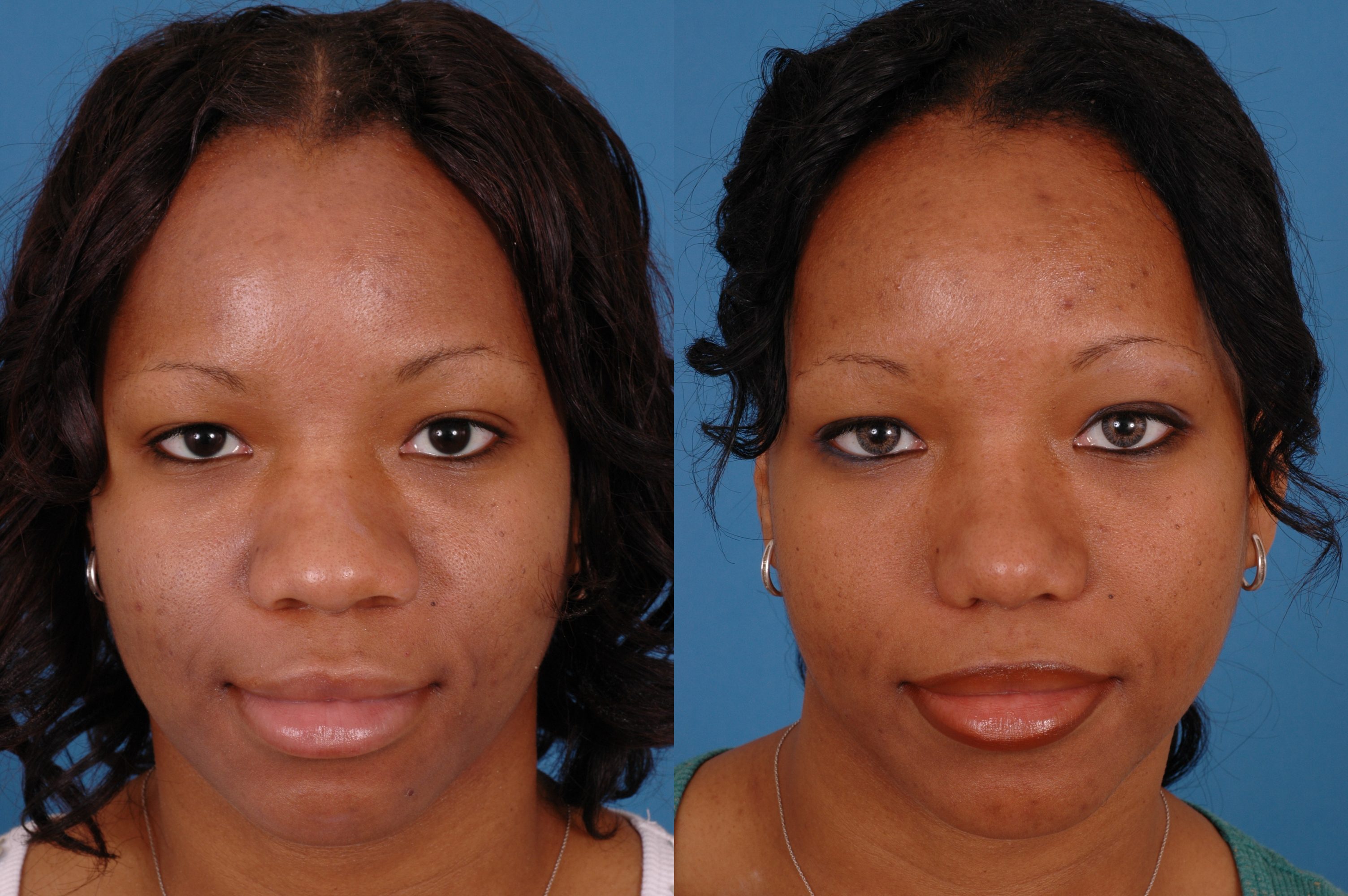 Rh Rhinoplasty – Dallas Advanced Facial Plastic Surgery Center