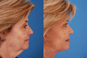Patient 1 Neck Lift Before and After