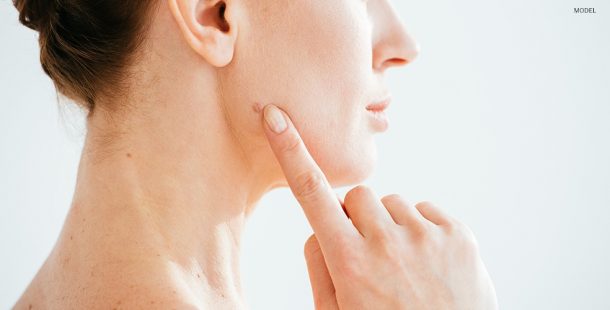 Close Up of Model's Face Pointing to Mole on Cheek