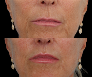 Lip Augmentation Dallas Texas