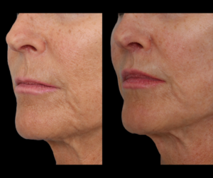 Lip Augmentation Results Dallas Texas
