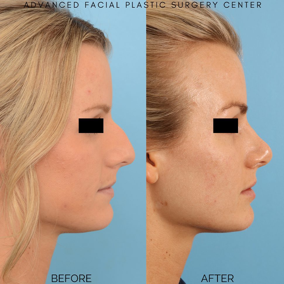 Before and After, Facial Plastic Surgery Center