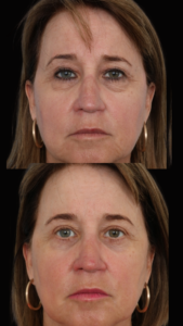blepharoplasty Results Dallas Texas
