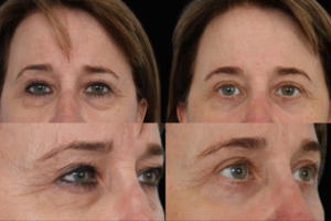 blepharoplasty Dallas Texas