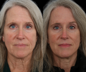 Dallas Texas Facelift Procedure