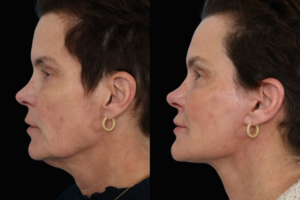 Facelift Results Dallas Texas