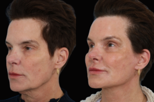 Facelift procedure Dallas Texas
