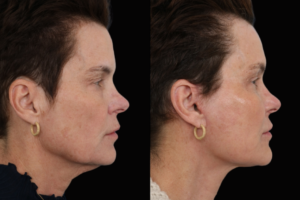 Facelift Dallas Texas