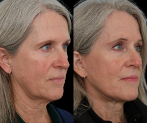 Facelift Patient Before and After