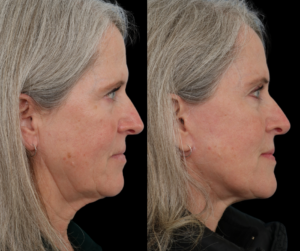 Facelift Before and After Dallas Texas