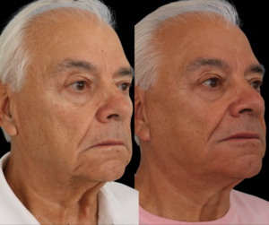 Male facelift dallas texas