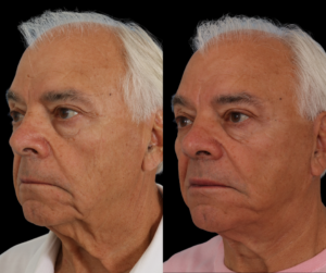 dallas texas facelift