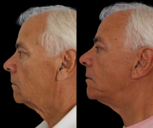 Male facelift patient dallas texas
