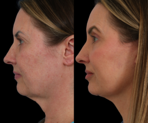 Dallas Texas Facelift Patient Before and After