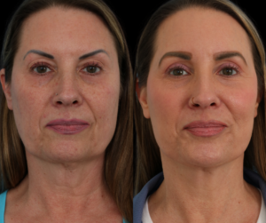 Female facelift dallas texas