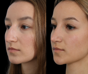 Rhinoplasty Surgery Dallas Texas
