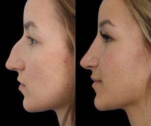 Rhinoplasty Patient Before and After