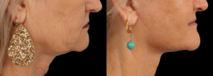 Neck Lift Patient Results Dallas Texas