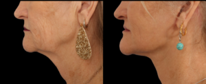 Neck Lift Real Patient Results Dallas Texas